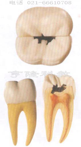 人體解剖模型|右測第一下磨牙蛀牙模型